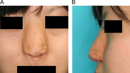 The patient was followed for 10 years after the third operation, and there were no complications, such as infection, malpositioning, or exposure of the hydroxyapatite implant. (A) Frontal view. (B) Lateral view.