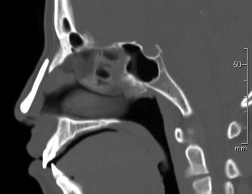 Computed tomography revealed no resorption or malpositioning of the implant 10 years after implantation.