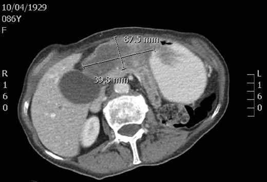 A computed tomography scan revealing a large, irregular, solid mass in the gastric fundus.