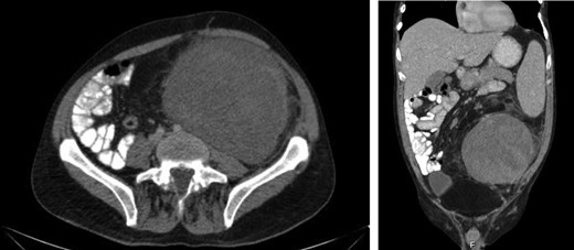 Axial and coronal CT images demonstrates the large retroperitoneal mass (50 × 33 × 16 cm) displacing bowel, the left kidney, left iliac vessels and bladder to the right.