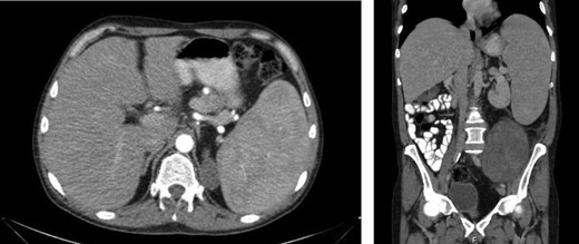 An enlarged spleen (16 × 10 × 22 cm) was identified on CT imaging obtained as part of the work-up of a palpable left abdominal mass.