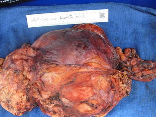 Pathologic analysis of the retroperitoneal mass returned as a high-grade dedifferentiated liposarcoma.