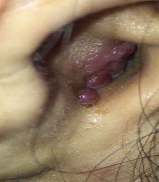 Showing reddish to pinkish nodular lesion at outer part of external auditory canal of left ear.
