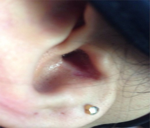 Picture of same pt. at 9 months follow-up post op.
