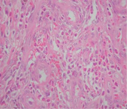 Histopathological picture of the lesion showing plump endothelial cells and surrounded by a lymphoid infiltrate with formation of germinal centers. Large numbers of eosinophils are also seen.