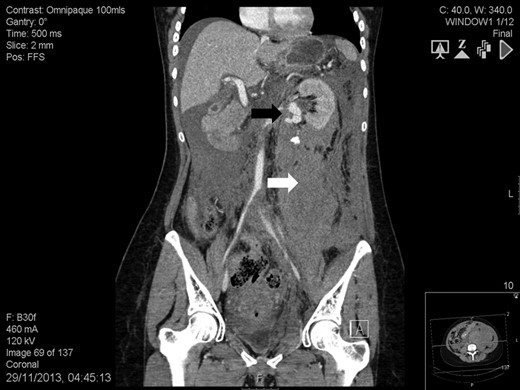 Abdomen contrast-enhanced computed tomography scan: massive retroperitoneal haematoma (white arrow) with active bleeding from a ruptured 2-cm left renal artery aneurysm (black arrow).