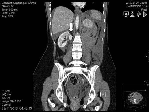 Abdomen contrast-enhanced computed tomography scan showing an intact 2.2-cm right renal artery aneurysm (white arrow).