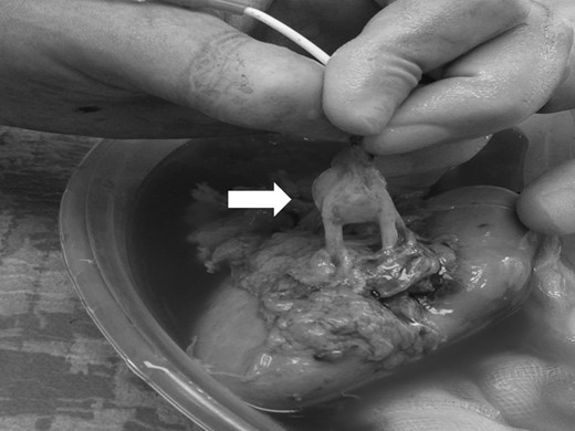 Intra-operative finding: right saccular renal artery aneurysm (white arrow) involving the main arterial branch and extending to the level of its distal bifurcation.