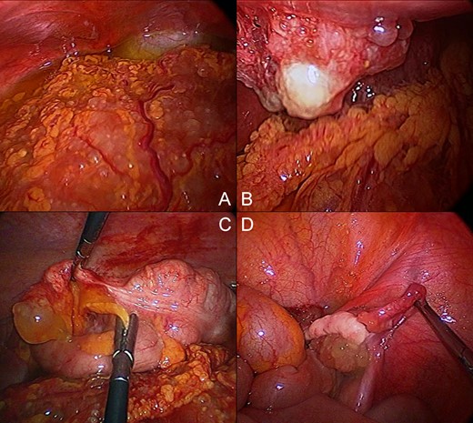 Mucinous tumor implants: (A) Omentum; (B) Anterior abdominal wall defect; (C) Appendix; (D) Right ovary.