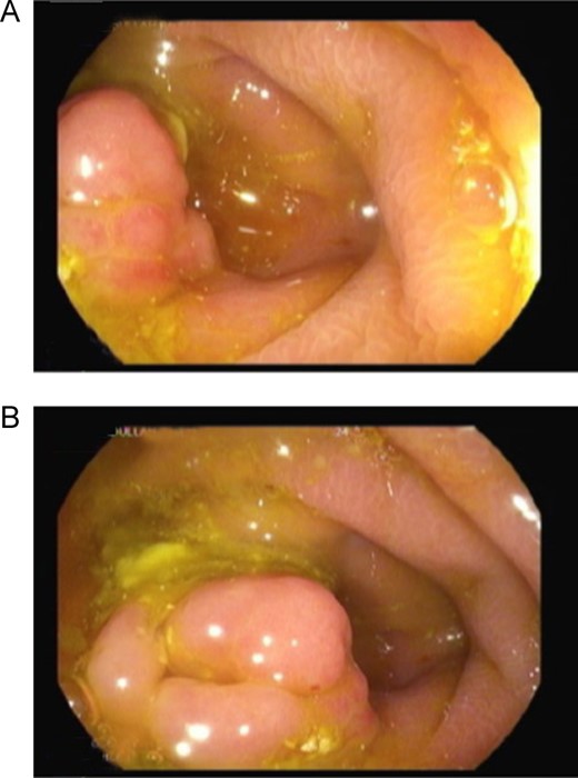 Colonoscopy images showing a bulging, erythematous nodular lesion at the base of the caecum.