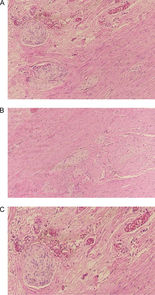 Histopathological examination of the appendiceal specimen revealed hypertrophied bundles within lamina propria consistent with appendiceal schwannoma (A, B, C).