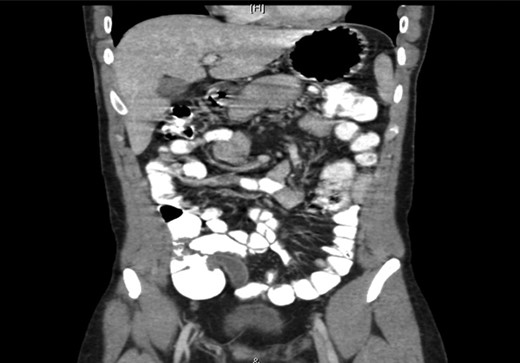A computed tomography scan of the abdomen showing a dilated appendix with no surrounding fat stranding or free fluid. The wall of the appendix was not interrupted. The liver, spleen, adrenal glands, kidneys, pancreas appeared unremarkable. No free air or free fluid was noted in the abdomen or pelvis. Overall, the findings were consistent with sub-acute appendicitis.