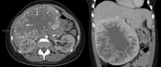 Abdomino-pelvic computed tomography (AP-CT) – voluminous heterogeneous liver mass in segments 4, 5 and 8 with 19 cm in diameter.