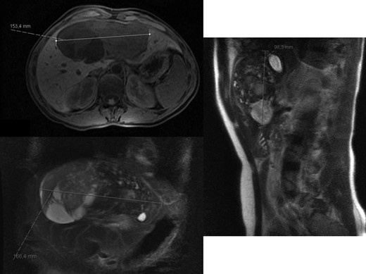 Abdominal Magnetic Resonance – heterogeneous liver mass in segment 4 with 16.6 cm.