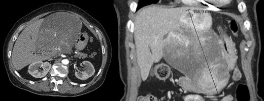 AP-CT – voluminous heterogeneous mass in segment 1 with 18.5 cm in diameter.