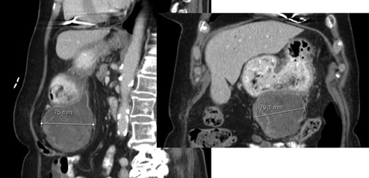 AP-CT – expansive heterogeneous lesion, with 7.4 cm, showing no cleavage plan with the stomach.