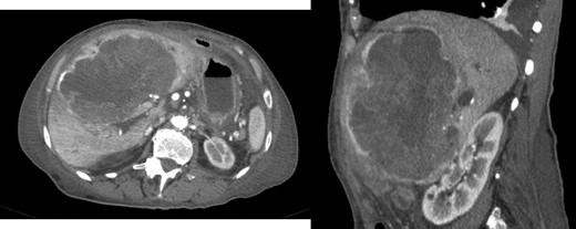 AP-CT – hepatic lesion causing compression of hepatic hilum.