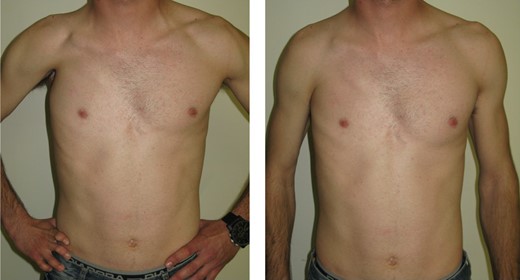 Photo showing the 28-year-old male with absence of all middle phalanges of the right hand and other rare anomalies due to Poland Syndrome. Preoperative view appearance.