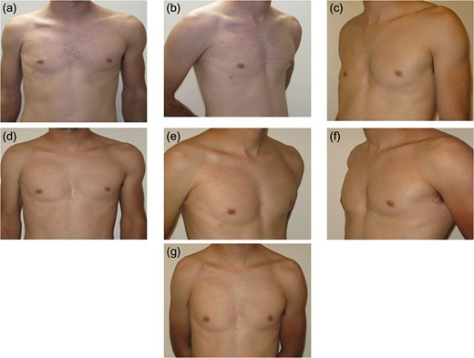 Serial photos showing the changes between 2 months after the first surgery and 3.5 year follow-up: (a–c) View 2 months after the first surgery. (d) View 4 months after the first surgery. (e) 8 months after the first surgery. (f) View 7 months after the second surgery. (g) View 3.5 years after the reconstructive procedure.