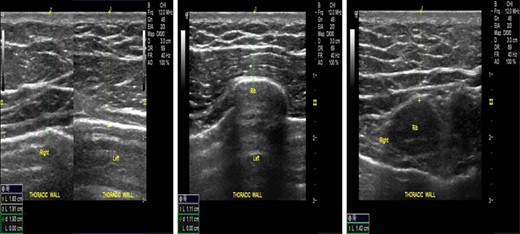 Serial soft tissue thoracic ultrasound photos 3.5 years after the first surgery indicating no pathologic findings.