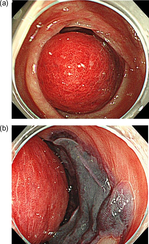 Findings at colonoscopy: (a) A submucosal tumor with a reddish surface and no active bleeding measuring 5 cm in diameter was observed in the descending colon. (b) The mucosa surrounding the submucosal tumor, especially on the opposite side, had mucosal hematoma formation.