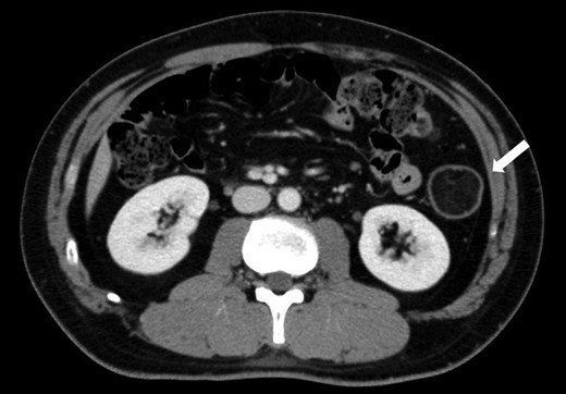 CT findings at the time of diagnosis: contrast-enhanced CT of the abdomen at the time of diagnosis revealed a solid mass measuring 5 cm in diameter with fat density in the descending colon (white arrow).
