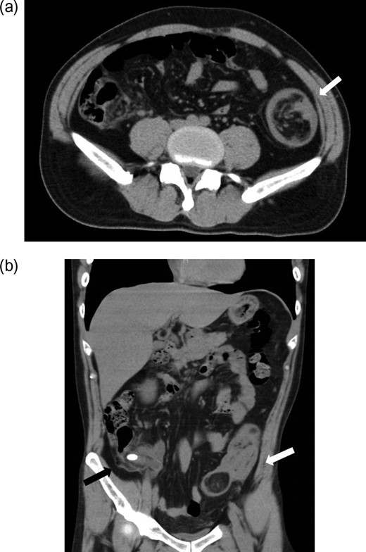 CT findings at the time of readmission: CT of the abdomen at readmission (a: axial view, b: coronal view) demonstrated antegrade colo-colonic intussusception with the lipoma in the descending colon as the lead point (white arrow). The appendix was also found to be swollen with a high density mass suspected to be a fecalith in the lumen, with inflammation in surrounding tissues (b, black arrow).