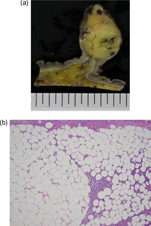 Surgical specimen and histopathological examination: (a) Macroscopically, the surgical specimen revealed a lipoma covered by normal colonic mucosa with well-demarcated, bright yellow texture. (b) Histopathological examination indicated mature adipose tissue (HE ×400).