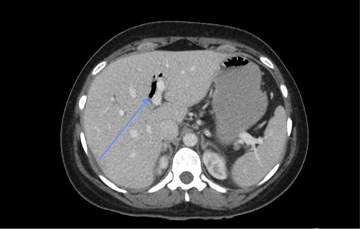 CT scan showing pneumobilia (arrow).