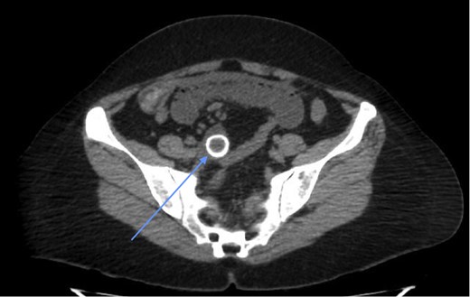 CT scan showing a rim-calcified gallstone, causing ileal obstruction.