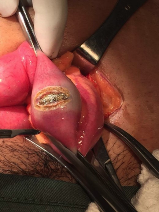 Simple enterolithotomy.