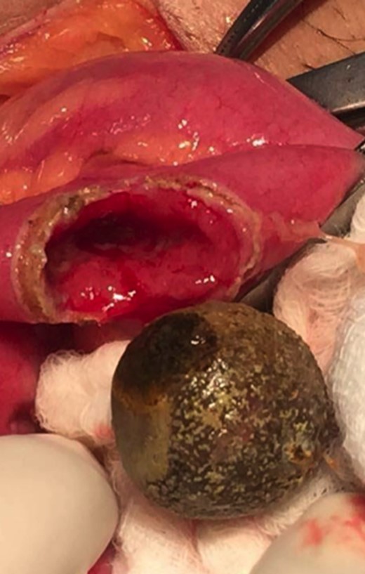 Gallstone after delivery by enterolithotomy. The gallstone measured 2 cm in diameter.