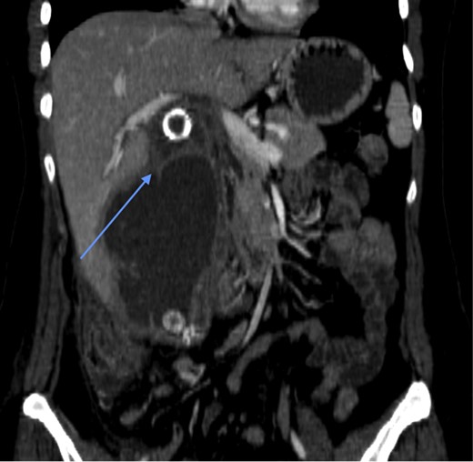 CT scan prior to cholecystectomy, 12 months earlier, showing calcified gallstones within gallbladder empyema and a septum-like narrowing (arrow) between the neck and the grossly distended empyema.
