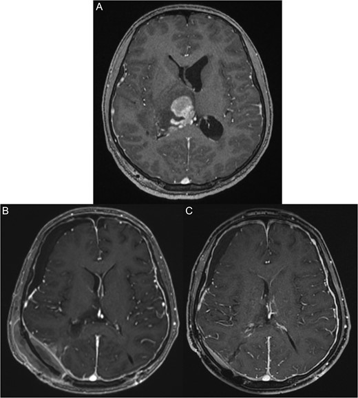 (A) Pre-operative magnetic resonant imaging of the brain showing hyperintense large right thalamic lesion compressing the lateral ventricles. (B) Three days post-operative magnetic resonant imaging of the brain showing almost total resection expect few small inhasing nodules. (C) Two months post-chemotherapy and radiotherapy, magnetic resonant imaging show total disappearance of the mass and good radiological response.