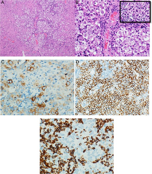 (A) Low magnification section from thalamic germinoma showed neoplastic cells arranged in large lobules separated by delicate lymphocyte-rich fibro-vascular septa. (B) High magnification of the same section showed uniform population of large polygonal cells with pale to clear cytoplasm, large centrally located vesicular nucleus, some nuclei were containing one or more prominent nucleoli, (inset) atypical mitosis neoplastic cells were positive for PLAP (C) and CD117 (D), while reactive lymphocytes were positive for CD45 (E).