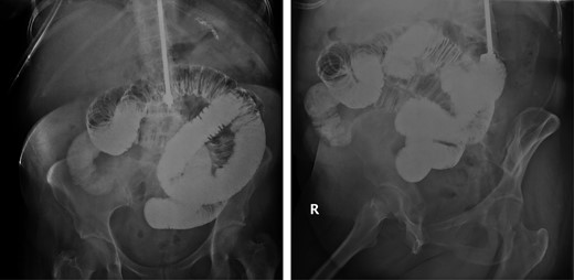 Small bowel follow-through with gastrograffin showing completed obstruction after 8 h in the mid-right lower mesogastric region.