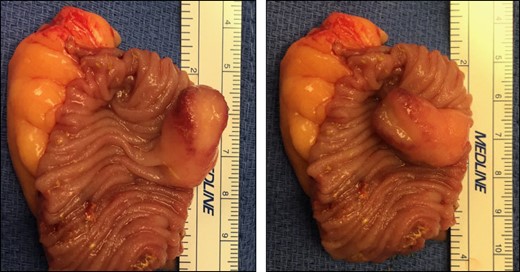 Resected small bowel with intraluminal lipoma.