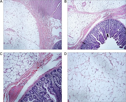 Histology of surgical specimen. (A) and (B) Submucosal lipoma with normal jejunum (H&E stain, ×40 magnification). (C) Submucosal lipoma with normal jejunum (H&E stain, ×100 magnification). (D) Lipoma (H&E stain, ×100 magnification).