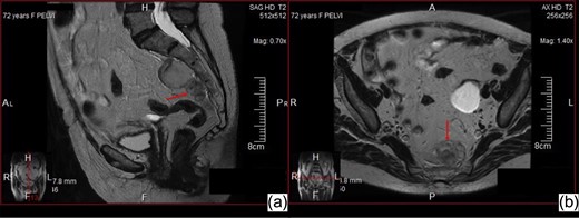 Abdominal MR sagittal (a) and axial (b) images—Solid expansive mass in the presacral area, with lobulated morphology, strictly adherent to the sacral periosteum, with adipose but non-homogeneous signal intensity.