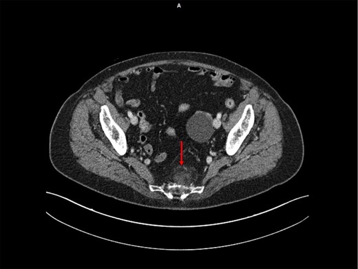 Abdominopelvic CT scan following injection of iodinated contrast agent—Presacral elongated formation of adipose density with multiple areas of structural not-homogeneity, with regular margins, adherent to the presacral fascia (but without bone infiltration) and with a modest enhancement after IV injection.