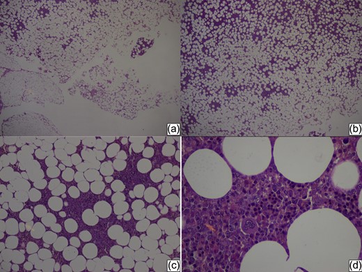 Histopathology of the tumor—Overview (a, b) of the tumor adipose tissue with area of cellular thickening, at the top left (HE stain ×5). At a magnification, HE stain ×20 (c) and HE stain ×40 (d) we can see elements of hematopoiesis: a multinucleated central megakaryocyte, an erythrone, which is the precursor of the erythroid line, and plasma cells with the carriage wheel nuclear chromatin.