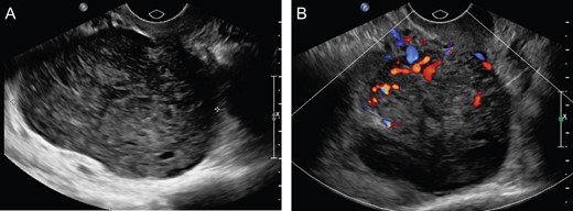 (A) Uterus measuring 5.9 × 3.4 × 2.9 cm3 with heterogeneously hypoechoic solid mass, measuring 5.5 × 4.9 × 7.5 cm3 right aspect of the uterus. (B) Color Doppler flow analysis with significant internal vascular.