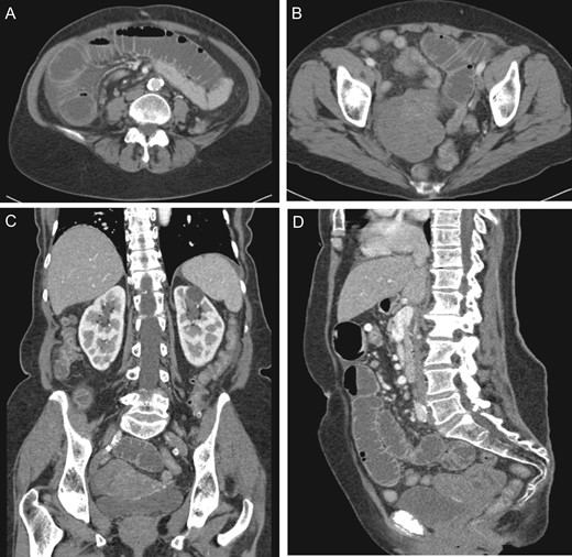 (A) Dilated small intestine with small amount of ascites. (B) Large heterogeneous pelvic mass. (C) Coronal view pelvic mass (arrow) with compression of bladder (arrow head). (D) Sagittal view pelvic mass.