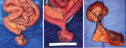 (A) Eviscerated small intestine with pedunculated mass. (B) Pedunculated mass with forceps indicating site of volvulus resulting in luminal narrowing from compromised blood flow. (C) Small bowel segmental resection.