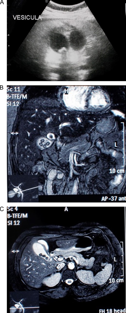 (A) Abdominal ultrasound revealing two gallbladders. (B) A magnetic resonance cholangiopancreatography revealing a normal liver and a gallbladder duplication with inflammation signs in one of them. (C) A magnetic resonance cholangiopancreatography revealing a gallbladder duplication with independent cysts ducts that joined in a common cystic duct before entering the common bile duct.