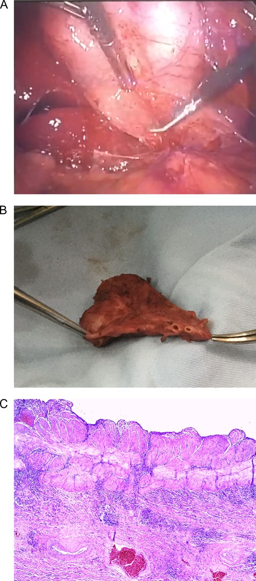 (A) Laparoscopic view of two gallbladders, each with its’s individual cyst duct and an oedematous wall in one of them. (B) Gallbladder duplication with two independent cystic ducts. (C) Thickened muscular layer and vascular congestion of gallbladder wall.