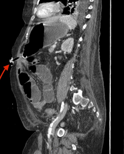 Sagittal CT scan of the abdomen. The arrow is pointing to the small bowel entrapped between the abdominal wall and stomach.