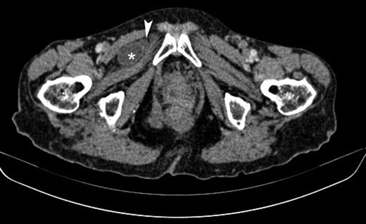 Axial contrast-enhanced CT image showing a small bowel loop (asterisk) appearing herniated and situated superficially to the obturator externus muscle and deep to the pectineus muscle on the right. Note is made of a small fluid collection adjacent to the herniated loop (arrowhead).