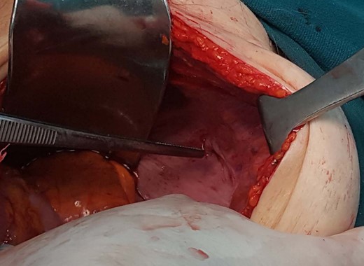 Obturator hernia defect.