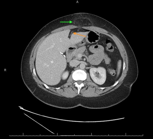 CT scan axial view showing the falciform ligament hernia (green arrow) and the falciform ligament above the left lobe of the liver (orange arrow).